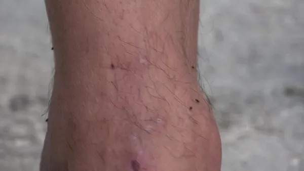 Bursa’da Korkutan Pire Alarmı! Ekipler Harekete Geçti
